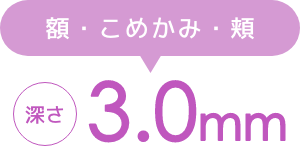 額・こめかみ・頬 深さ3.0mm